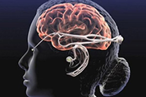 Neurotechnologie